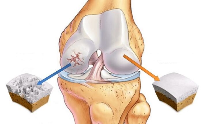 cartilagine sana e artrosi del ginocchio