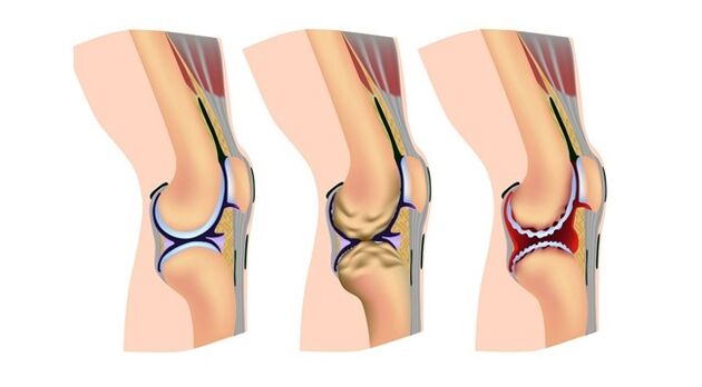 fasi dell'artrosi dell'articolazione del ginocchio