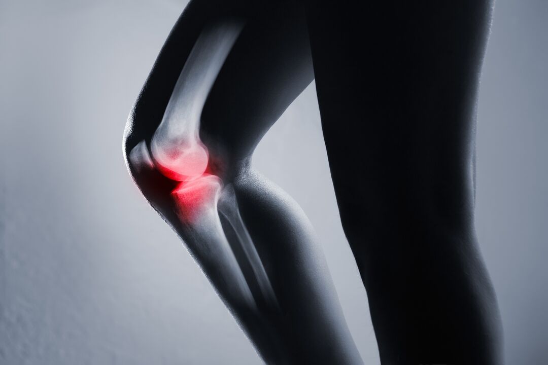 infiammazione dell'articolazione del ginocchio con artrosi