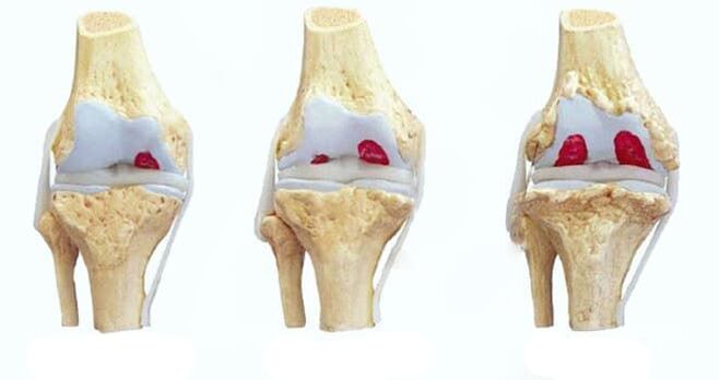 fasi dell'artrosi del ginocchio