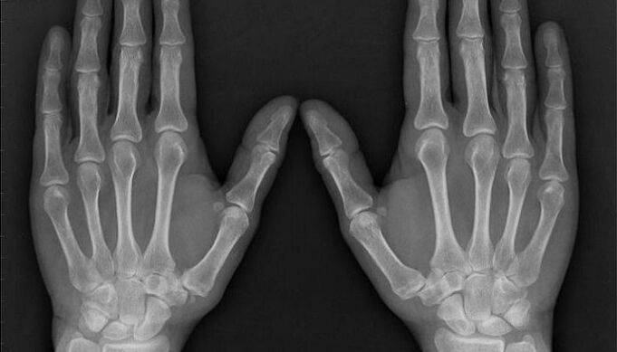 radiografia per la diagnosi di artrite e artrosi