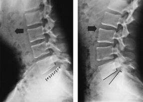spostamento delle vertebre nell'osteocondrosi toracica