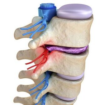 Un nervo schiacciato nella colonna vertebrale è accompagnato da dolore lancinante