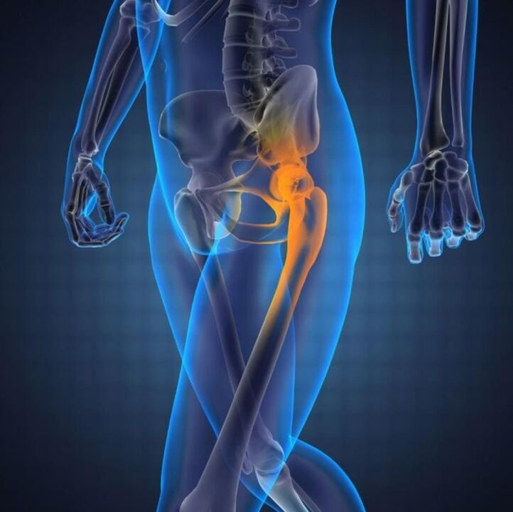 artrosi dell'articolazione dell'anca