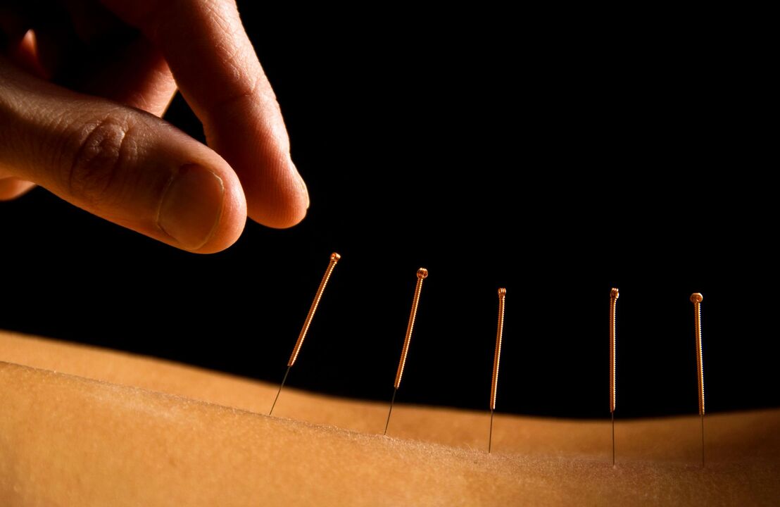 agopuntura per il mal di schiena