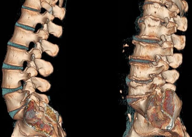 Osteocondrosi della regione lombare