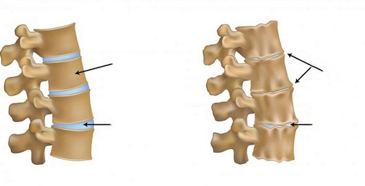Sindrome ischemica per osteocondosi