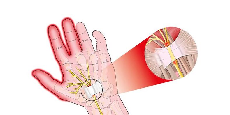 Dolore alle articolazioni delle dita con risartrosi