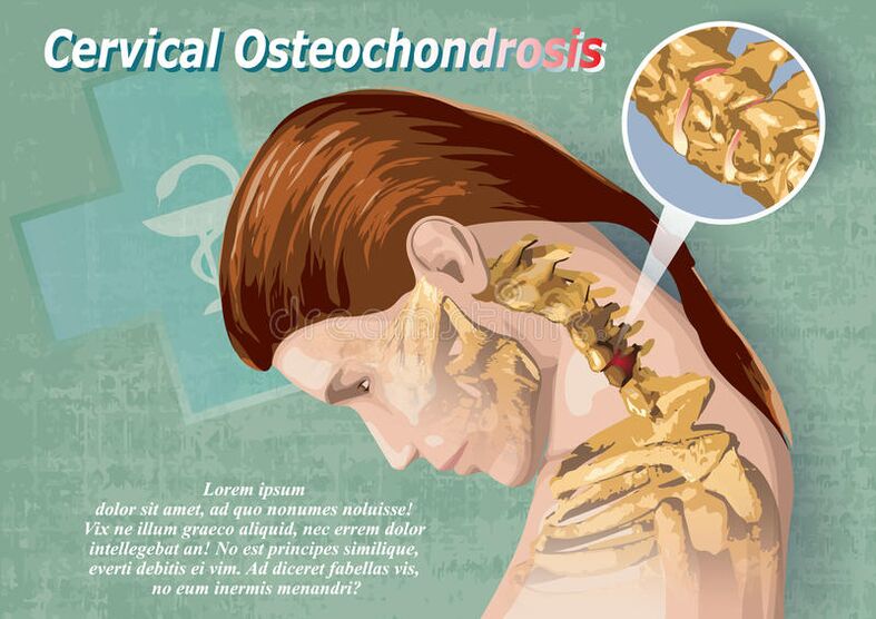L'osteocondrosi cervicale è una malattia del tessuto cartilagineo