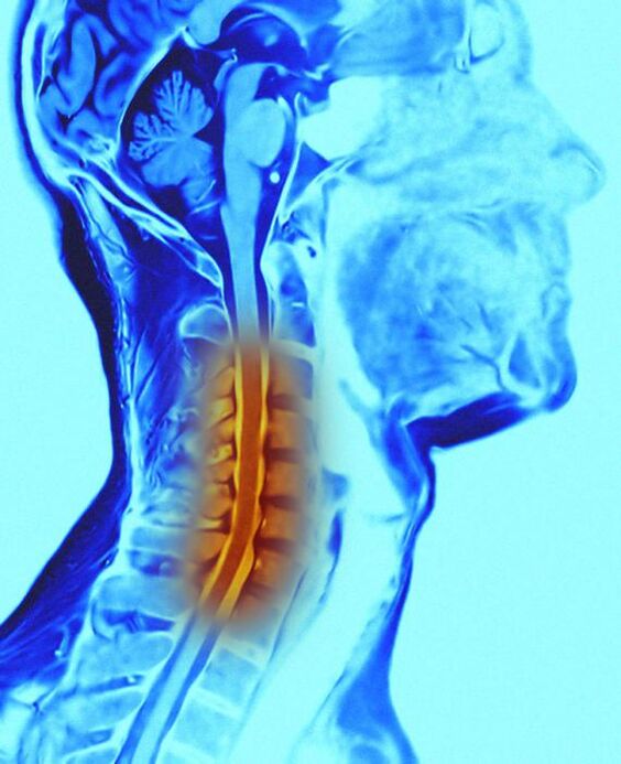 colonna cervicale e osteocondrosi