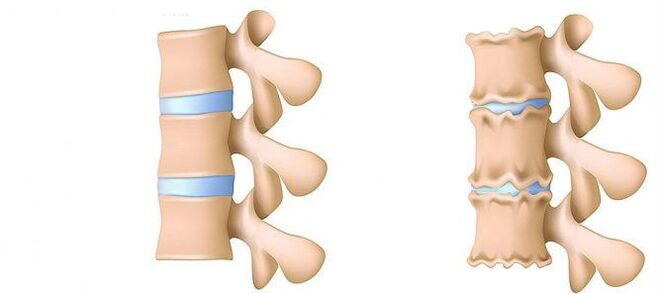 Osteocondrosi dall'interno